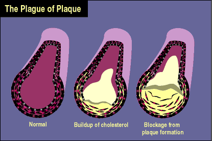 plaque buildup