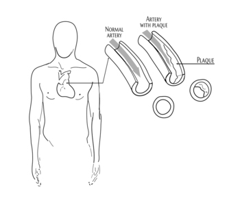 hardening arteries