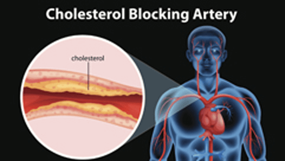 cholesterol-blocked artery